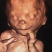 A picture of an infant with a large head.