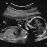 A picture of an ultrasound image of the stomach.